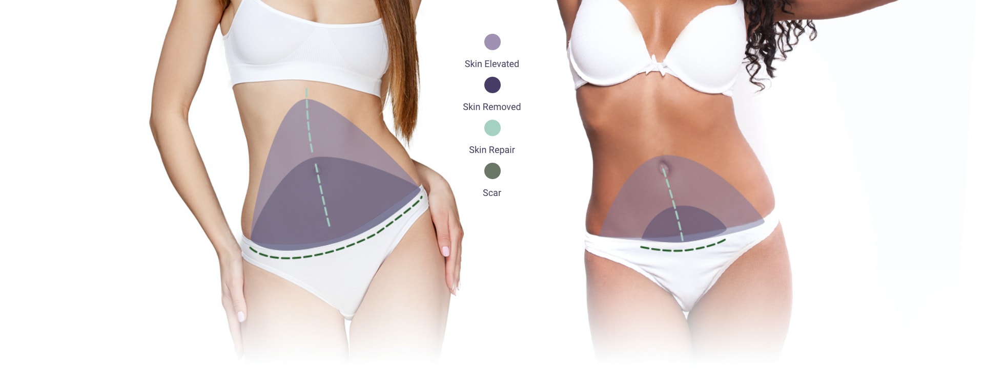 Your Checklist for a Perfect Tummy Tuck - Plastic Surgery